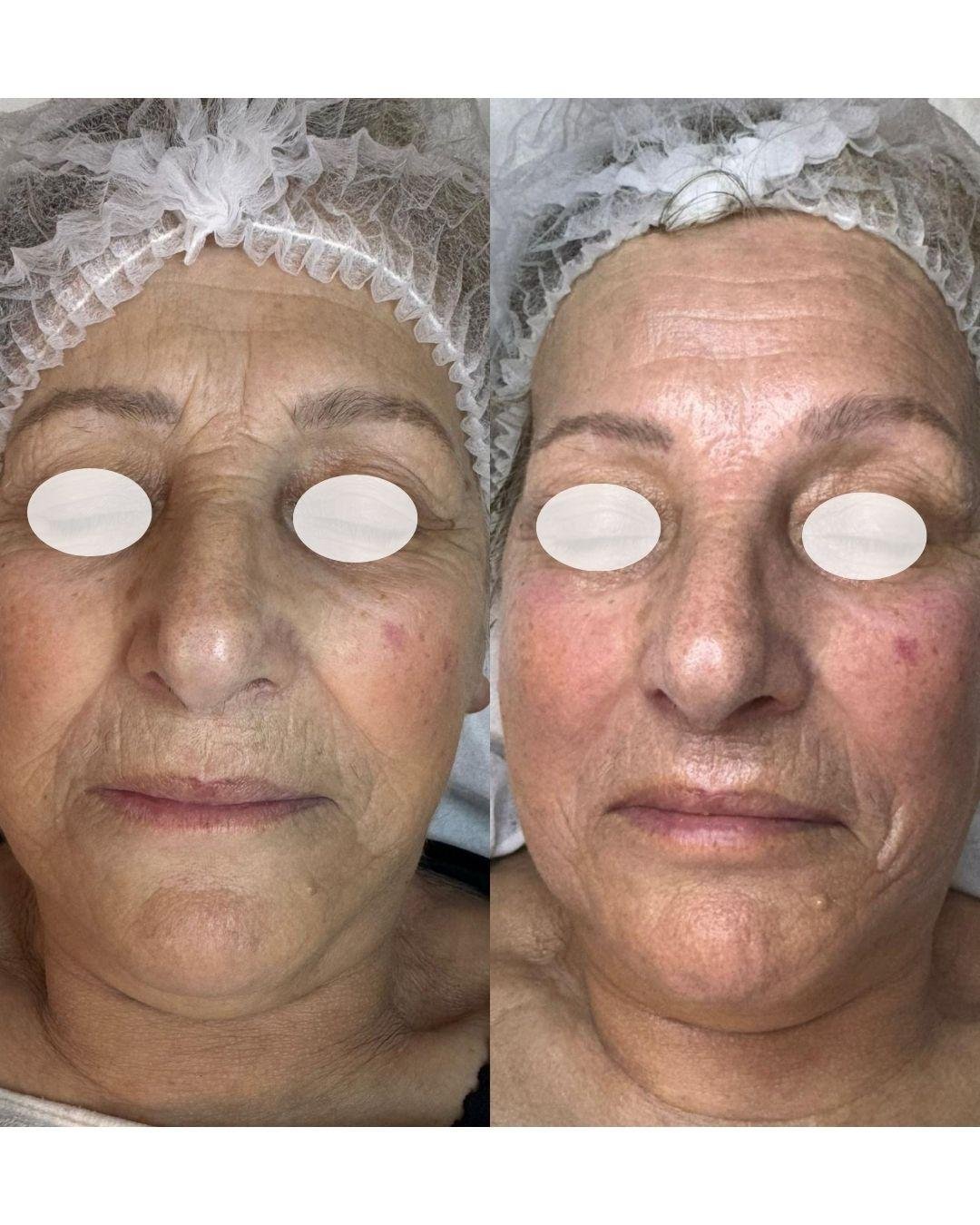 Tratamiento Facial con Ácidos Combinados Antiedad